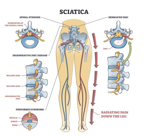 Causes of sciatica addressed in our Miami physical therapy clinic