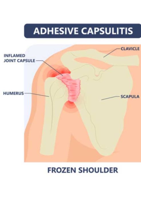 Frozen Shoulder