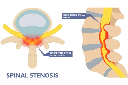 Spinal Stenosis
