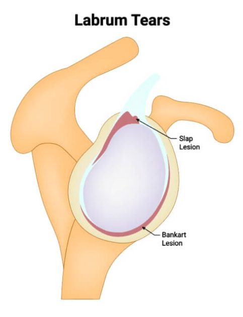 shoulder Labrum Tear